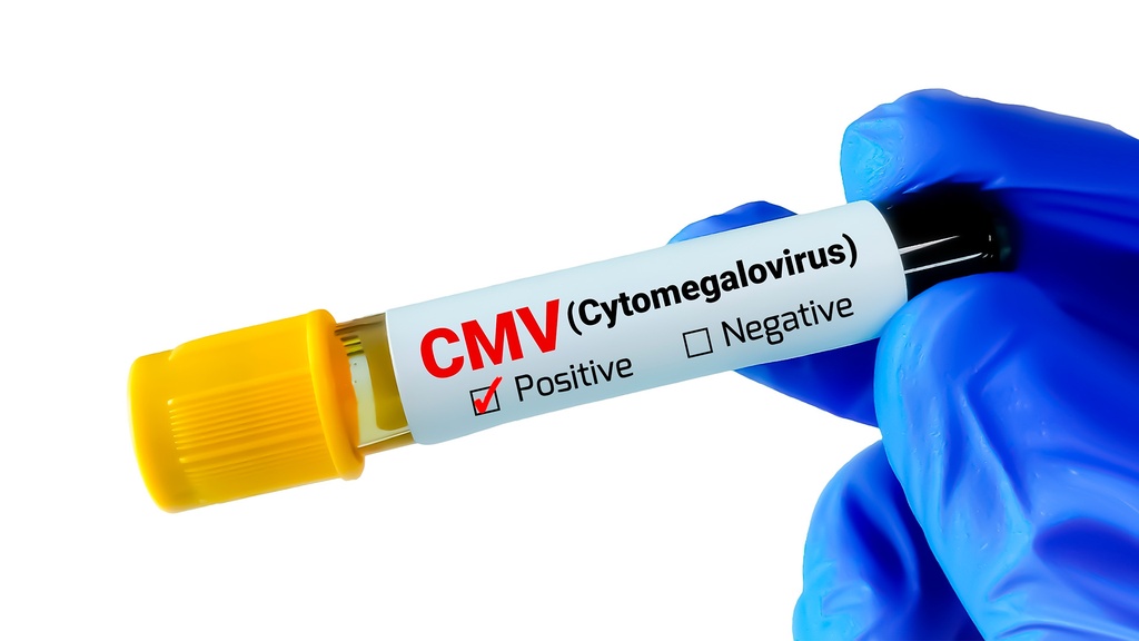 Ac. Anti - Citomegalovirus IgM