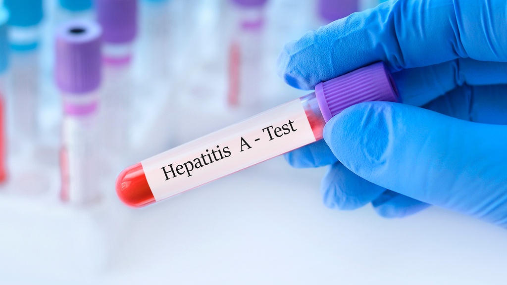 Ac. Anti - Hepatitis A (IgM)