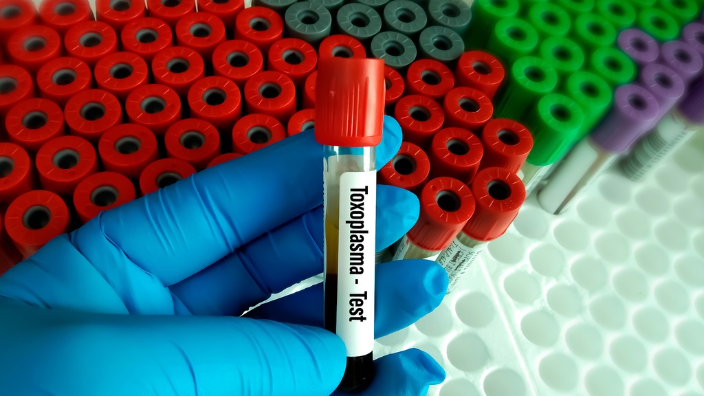Ac. Anti - Toxoplasma IgG