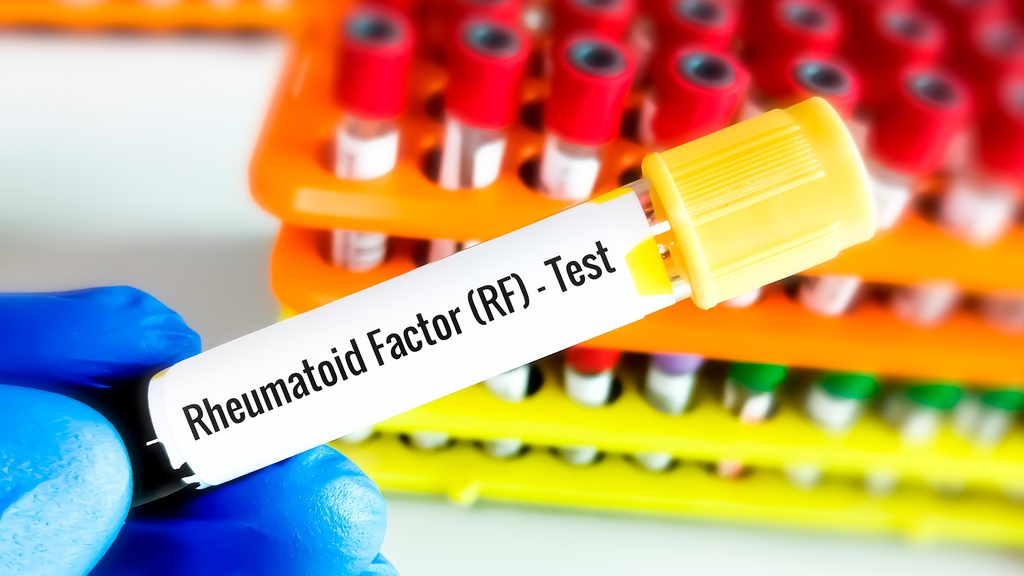 Factor Reumatoide