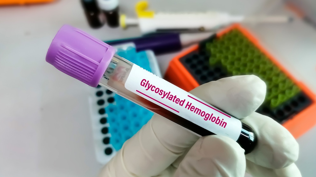 Hemoglobina Glucosilada (HB A1C) en sangre total