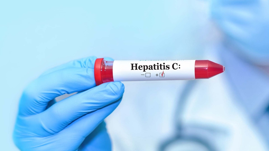 Perfil Hepatitis "C"