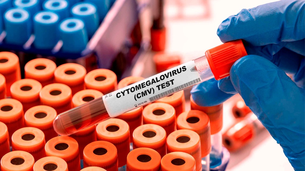 Ac. Anti - Citomegalovirus IgG