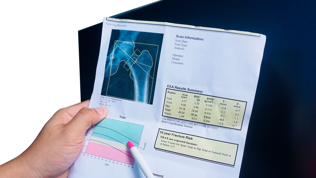 Densitometría Cadera