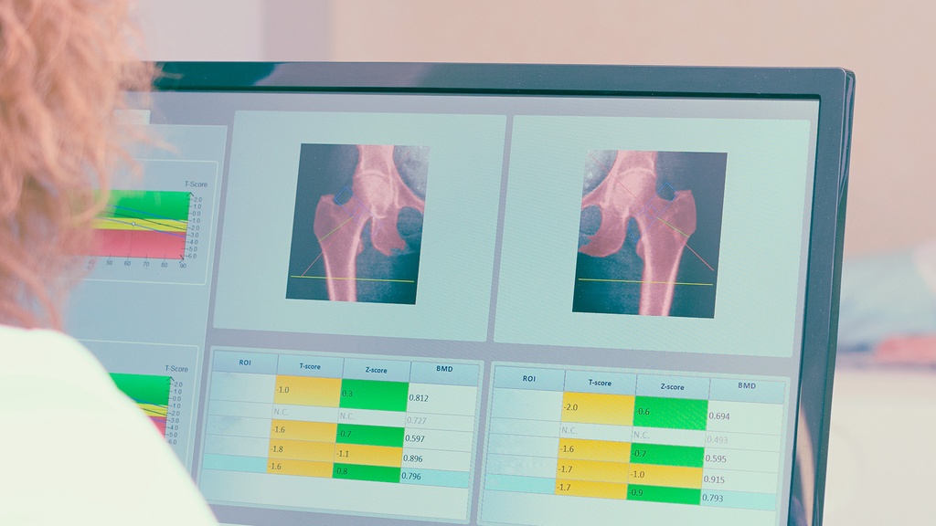 Densitometría Cadera Dual