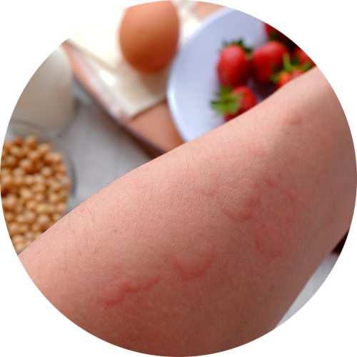 Perfil de Alergia Alimenticia (IgE)