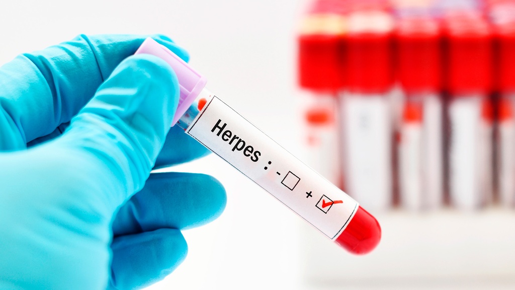 Ac. Anti - Herpes II IgM