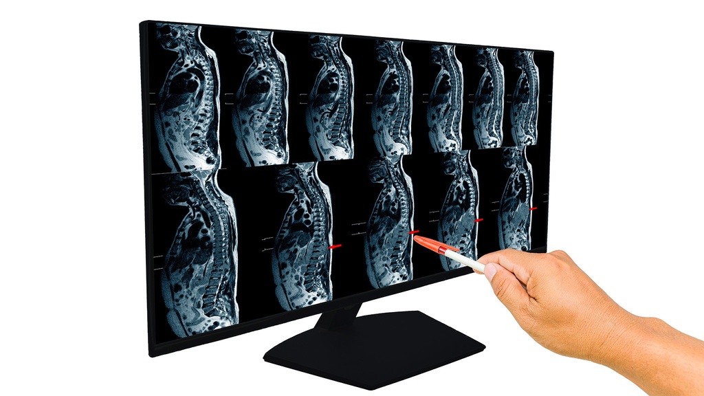 Resonancia Magnética Plexo Lumbar