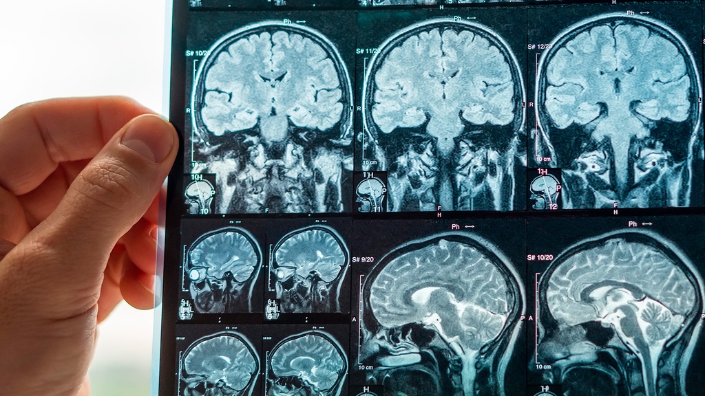 Resonancia Magnética Union Craneo Cervical