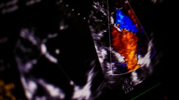 [USDCCU] Ultrasonido Doppler Color Cuello